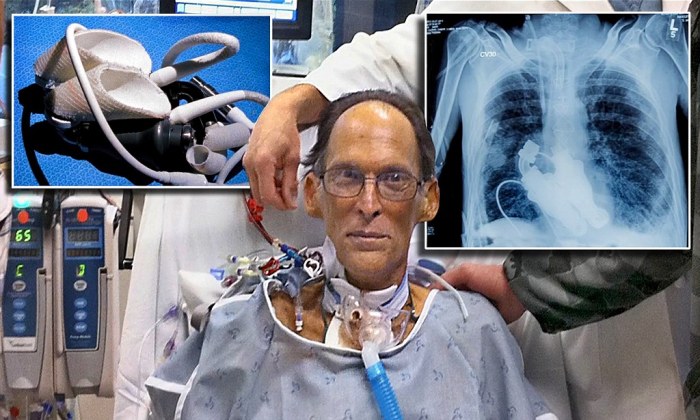 Man survives 17 months without a heart